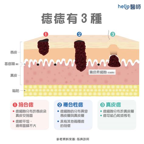 臉部痣|痣變大、痣多或長毛會變皮膚癌？認識痣的形成與原因